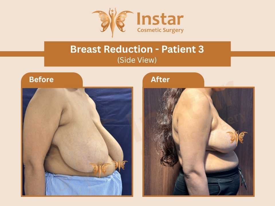 Breast Reduction (Side View)